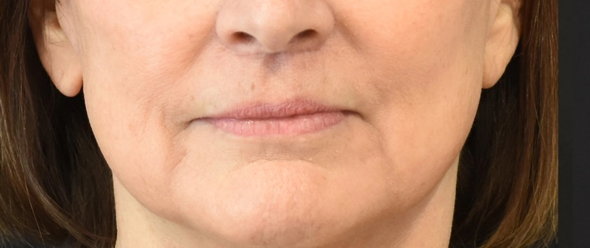 Lip Lift Patient 3 Set 1 After