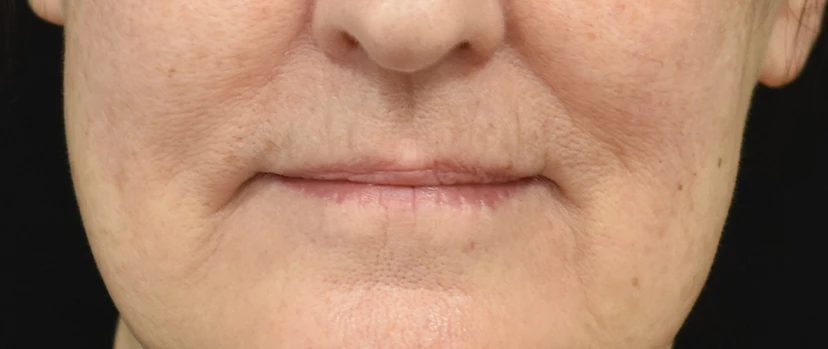 Lip Lift Patient 15 Set 1 Before